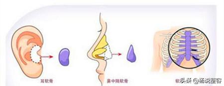 隆鼻失败修复的几点建议,隆鼻失败医生会马上为患者修复吗