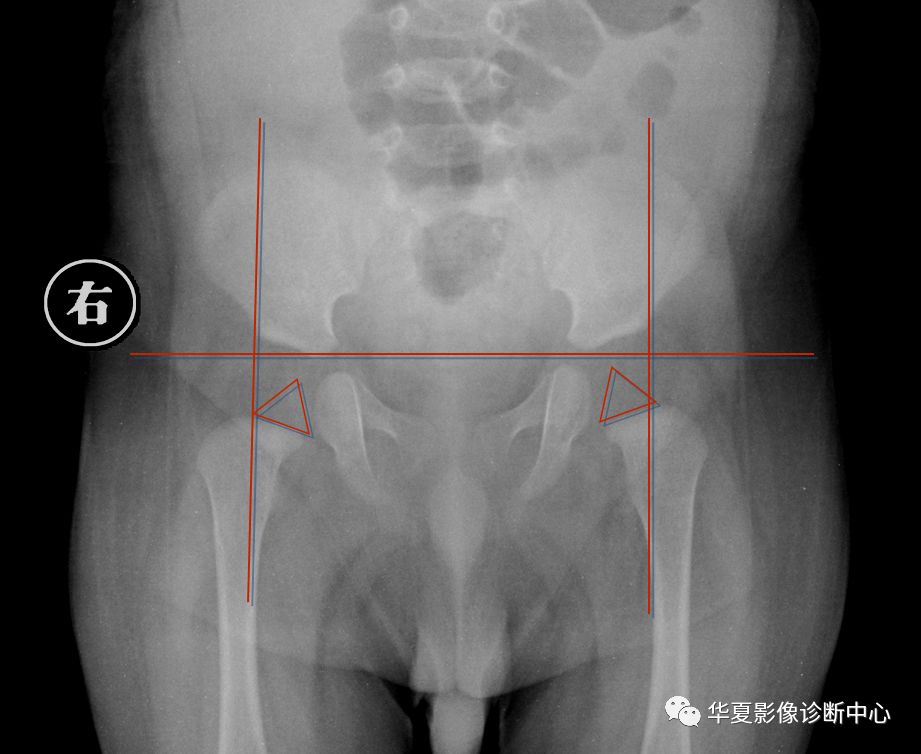先天性髋关节脱位饮食,先天性髋关节脱位属不属于残疾人