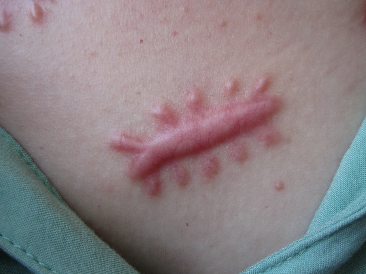 瘢痕疙瘩不治疗行吗,瘢痕疙瘩最新治疗方法