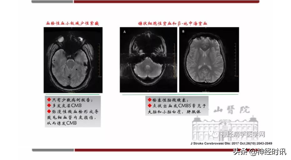缺血性脑血管病出血评估,脑血管微出血怎么治疗