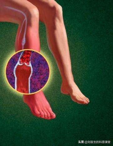 双腿静脉血栓肿怎么治疗,双腿血栓腿肿是什么原因