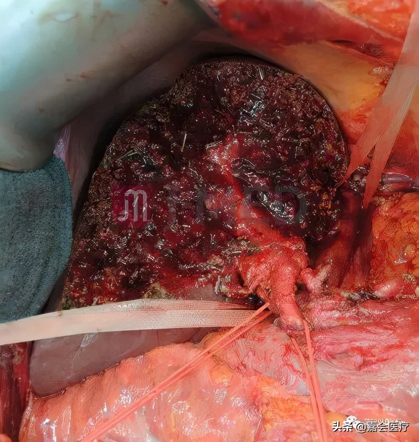 7mmx5mm肝癌能治愈吗,巨大型肝癌的治疗方法