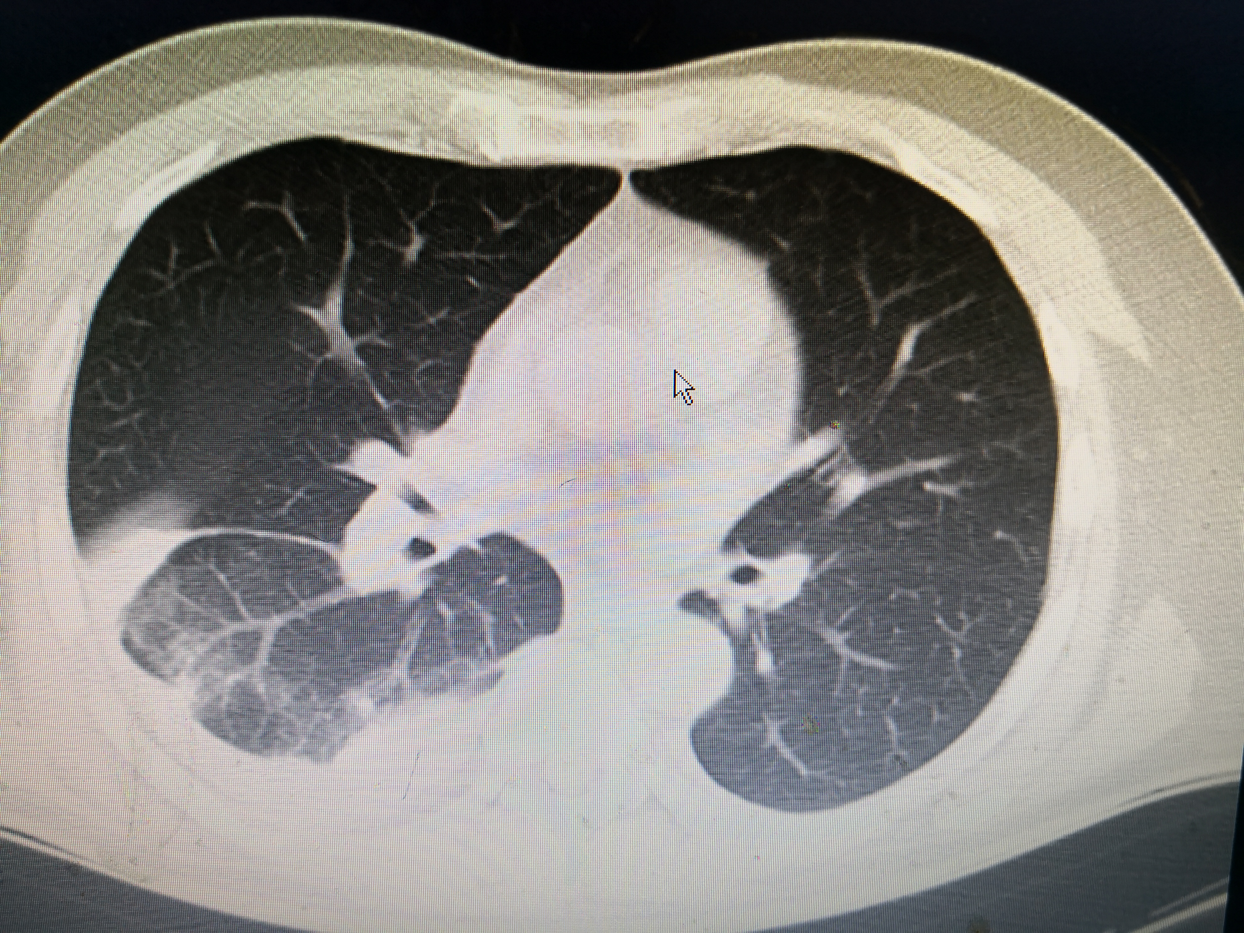 重症肺炎的急救配合要点,重症肺炎针对性护理措施