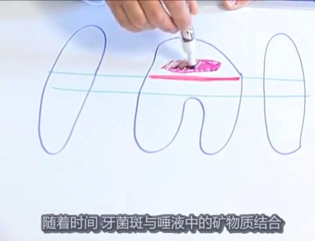 猫有牙结石牙龈红肿怎么治疗,猫已经有牙结石了怎么办