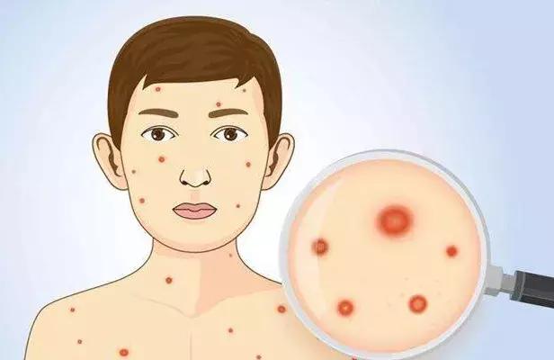 春天了,水痘进入高发期这些“战痘”知识你不能不知道