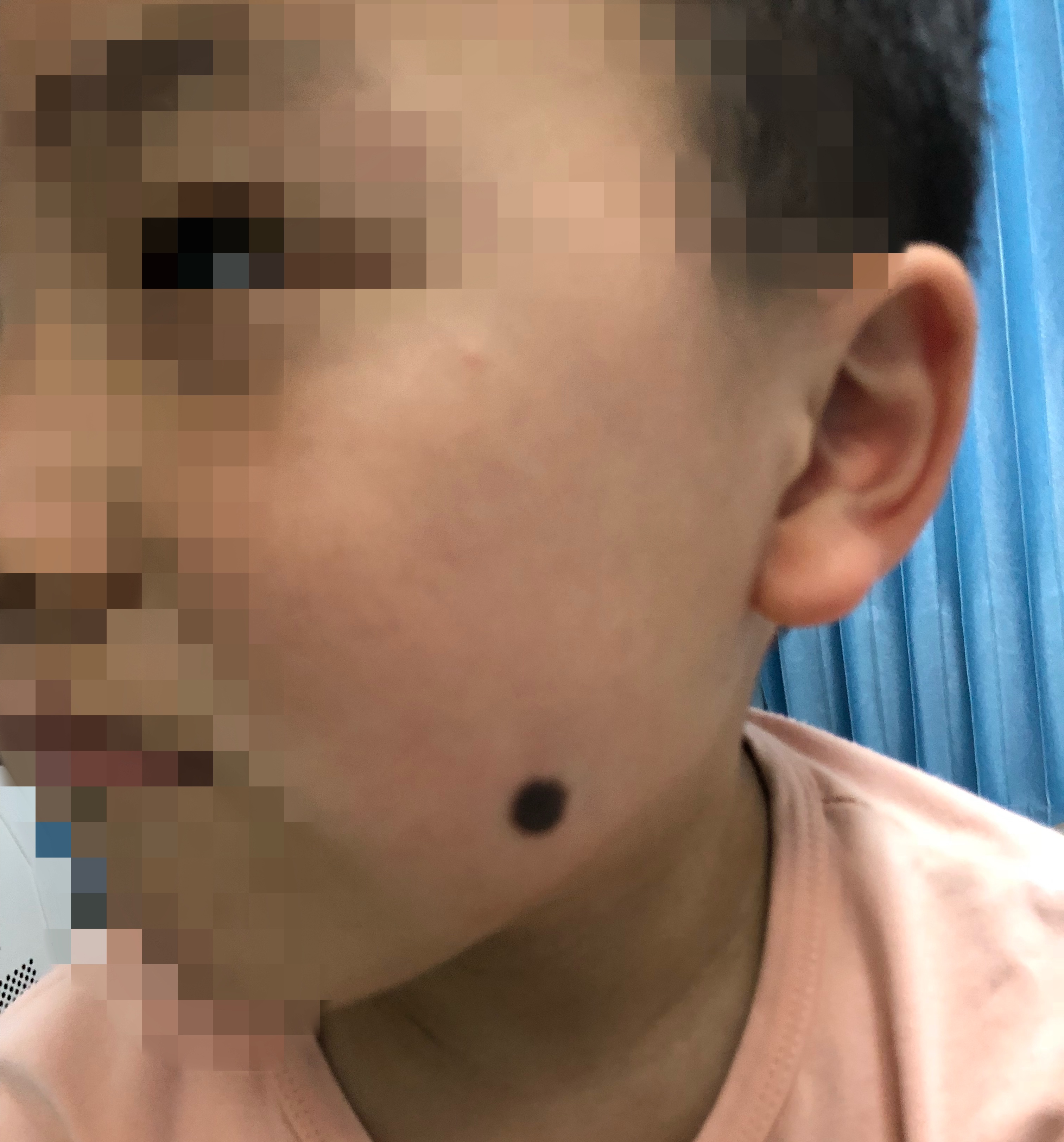 三厘米的痣手术切除要不要做皮瓣,头皮上有个凸起的痣要不要切除