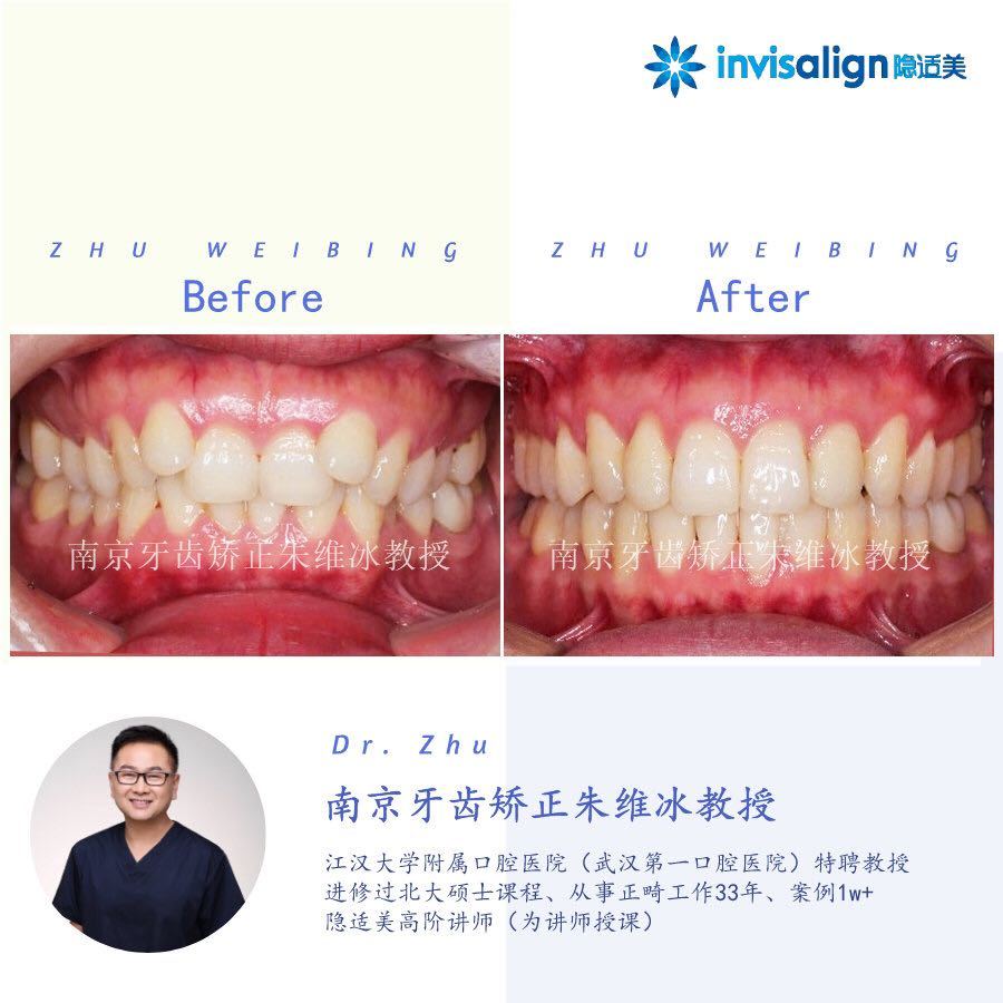 南京口腔医院矫正一颗牙齿多少钱,大医院为啥不建议做牙齿矫正