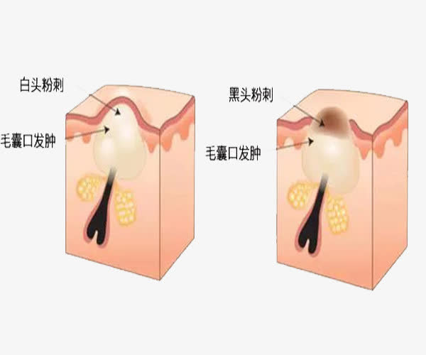 毛孔粗大怎么办什么方法有效,毛孔粗大怎么办怎样改善