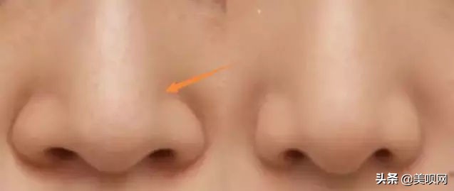 明星都在用的缩小鼻翼神器,明星鼻子做鼻翼缩小外切