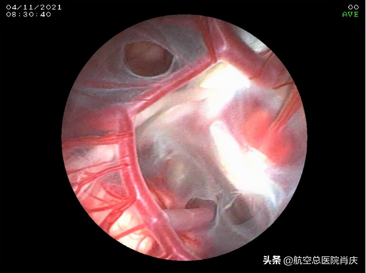 鞍上池蛛网膜囊肿手术费用,鞍上池蛛网膜囊肿影响智力吗