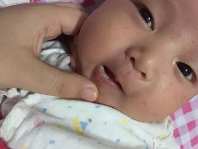 预防鹅口疮的最佳方法,如何预防婴幼儿鹅口疮