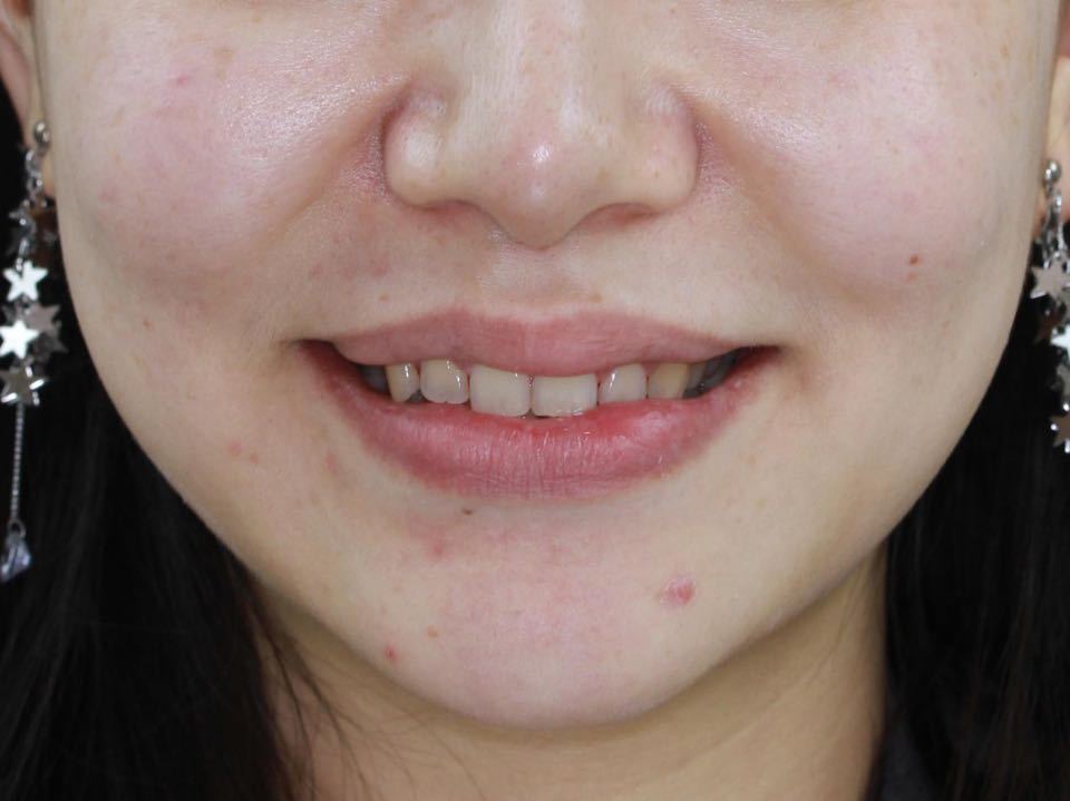 西安张军正畸医生如何,西安牙齿矫正案例