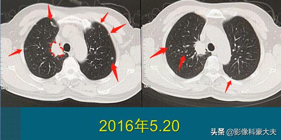 肺癌晚期脑转移用靶向药能活多久,肺癌晚期靶向治疗一般能活多少年