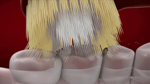 牙科牙齿美白全过程,牙齿黄又臭又烂牙怎么办