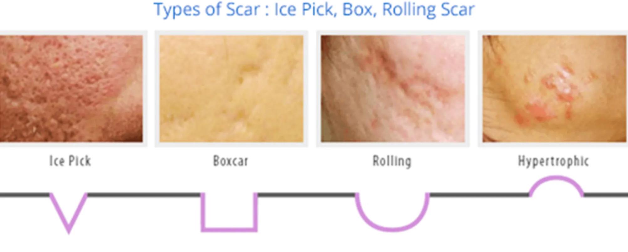 长疱疹的伤疤怎么治,长疮留下的红疤痕用什么药