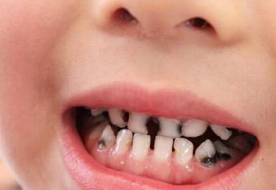 四岁孩子牙黑怎么回事,小孩满口黑牙不是吃糖是父母无知