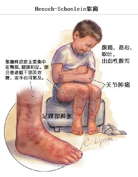 过敏性紫癜引起尿潜血怎么办,过敏性紫癜出现尿潜血