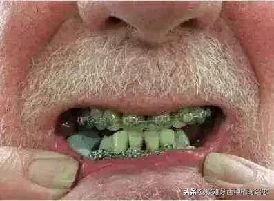 牙齿矫正最佳年龄中年,中年人龅牙可以牙齿矫正吗