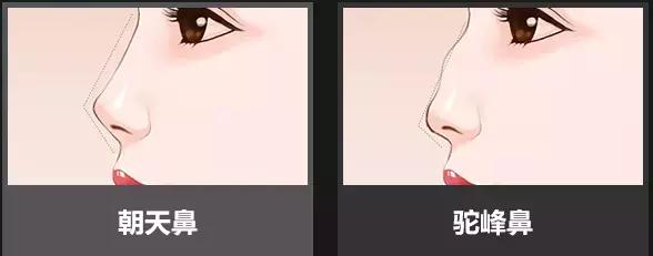 线雕隆鼻的注意事项有哪些,线雕隆鼻多长时间融为一体