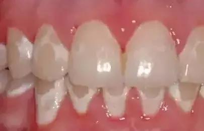 牙齿脱矿有必要治疗吗,牙齿脱矿龋齿可以不做牙贴面吗