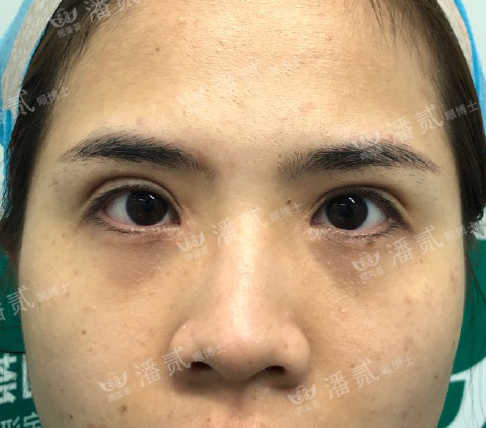 双眼皮手术后眼神凶狠是什么原因,双眼皮手术后显凶