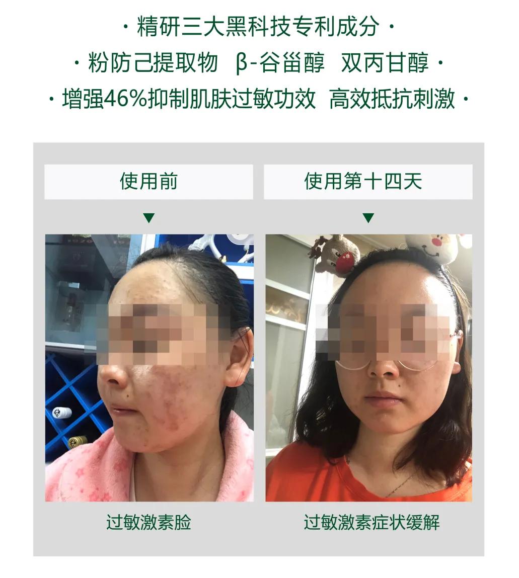 肌肤发红发痒怎么护理,泛红刺痛干痒如何修复