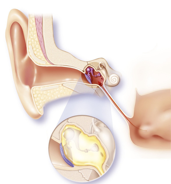 中耳炎迁延不愈,一家人反反复复得中耳炎