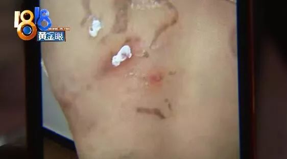 拔火罐酒精在背上烧着了咋办,女子拔火罐后背烧伤