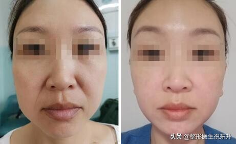 法令纹用什么方法去除效果好,去除法令纹的最有效的方法有哪些