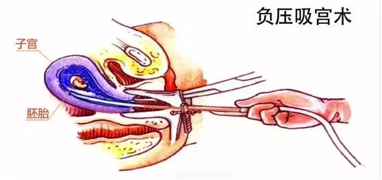 科学避孕关爱健康,科学高效避孕护航生殖健康