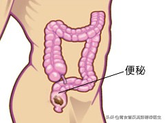 为什么很多女人都便秘,女性便秘的真正原因是什么