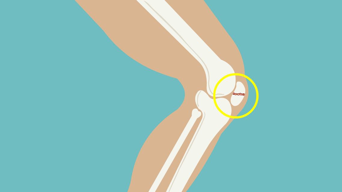 膝关节脱位，可以采取闭合复位，一般需要对关节内的血肿进行清除