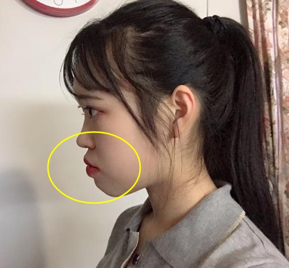 嘴凸法令纹怎么修容,嘴凸法令纹怎么消除学生党