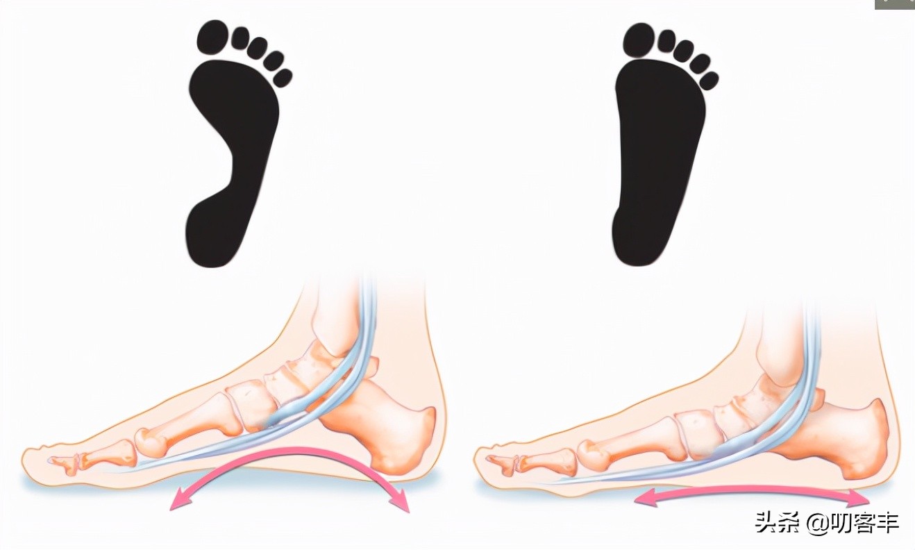 平足有什么好办法治疗,平足怎么办