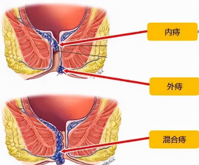 散步可治痔疮,睡前一招治外痔疮