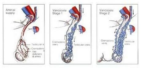 什么导致精索静脉曲张,仰卧起坐对精索静脉曲张有危害吗