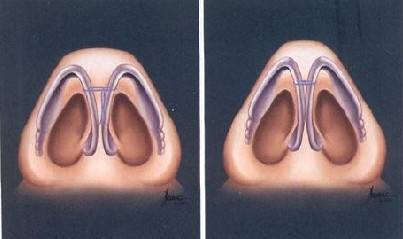 改善鼻尖整容多少钱,改善鼻头尖