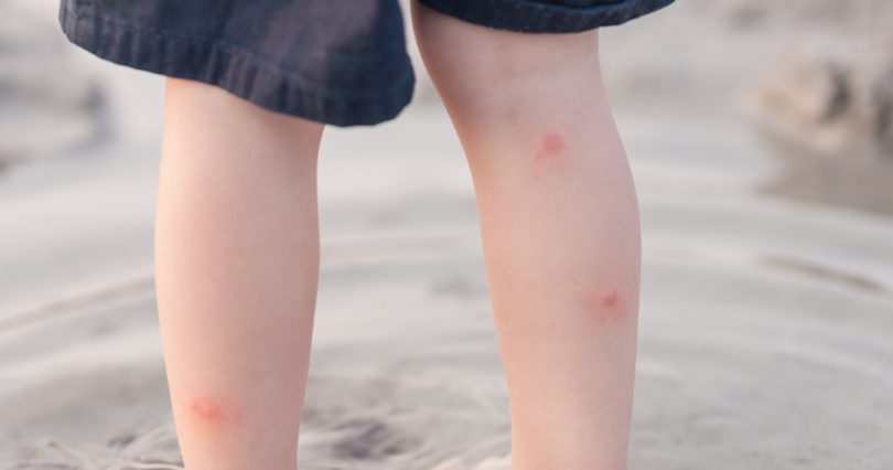 小孩脚扭伤积极治疗没有后遗症吧,孩子脚扭伤了肿了冷敷后要干什么