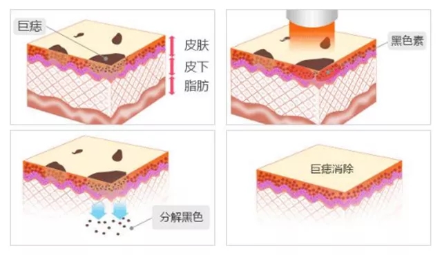 激光祛痣用什么药祛疤,激光点痣留疤几率多大
