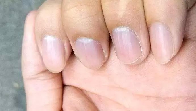 十岁孩子指甲上有竖纹是怎么回事,大拇指甲上有白色竖纹是怎么回事