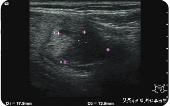 消融术治疗甲状腺结节要多久能好,甲状腺开刀还是消融术