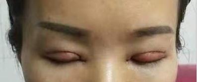 眼球突出割双眼皮好看吗,割双眼皮的危害