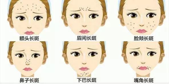 激光祛斑反黑多久能恢复正常肤质,祛斑后反黑能用美白产品吗