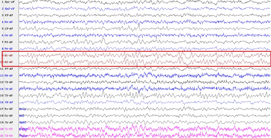 临床常见脑电图,教您三分钟读懂脑电图