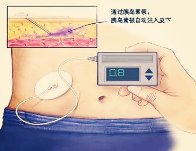 糖尿病用的胰岛素泵使用方法,糖尿病患者用泵调整基础胰岛素