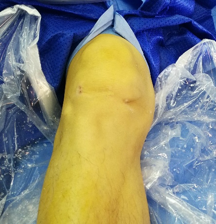 半月板损伤怎么办看完你就明白了,半月板损伤了要怎么好得快