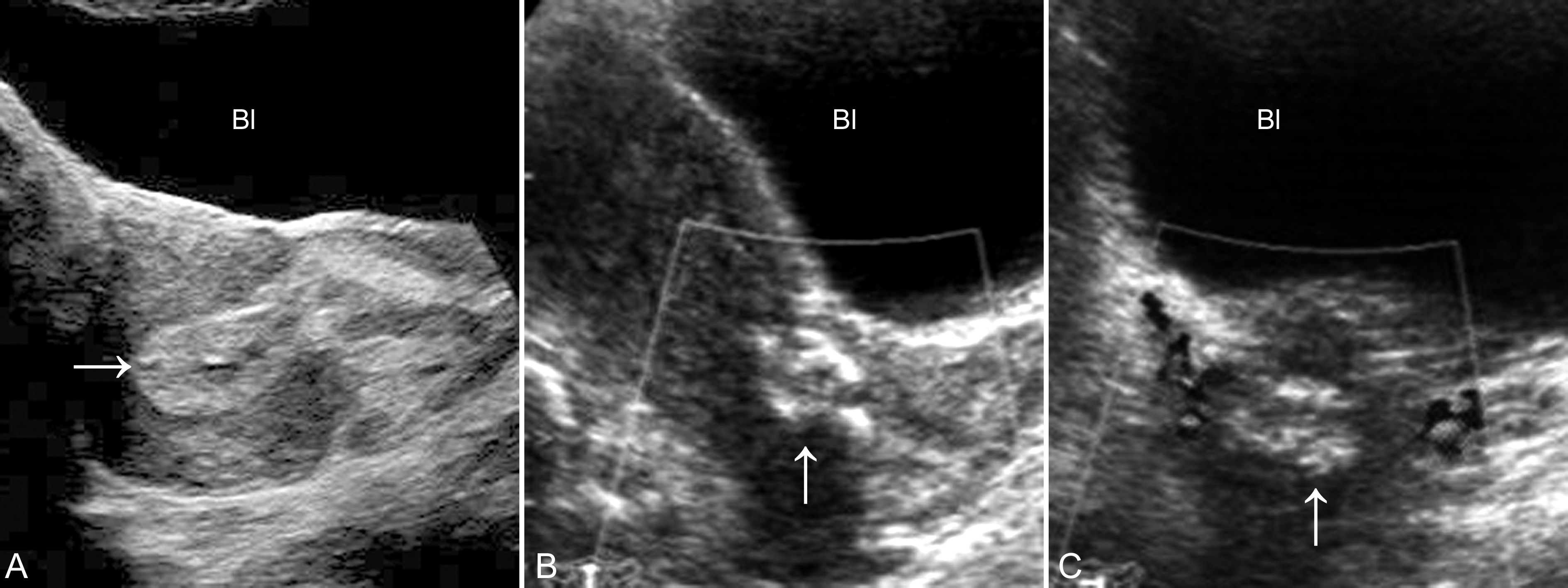 经阴超声检查可以看出来流产吗,流产残留超声诊断
