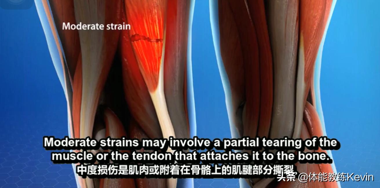 腘绳肌拉伤恢复训练方法,预防腘绳肌拉伤的方法