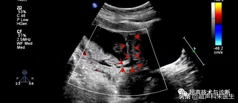 绒毛膜下血肿的超声鉴别诊断,绒毛膜下血肿的症状