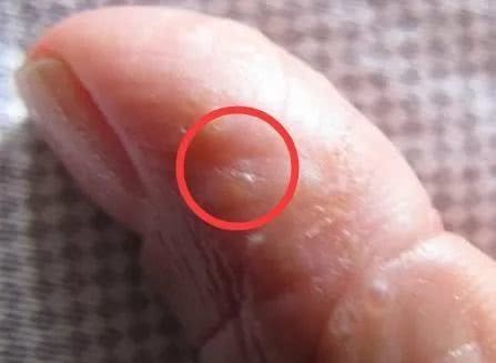 脚上手上长透明小水泡是什么原因,手上胳膊上有很多透明小米粒水泡